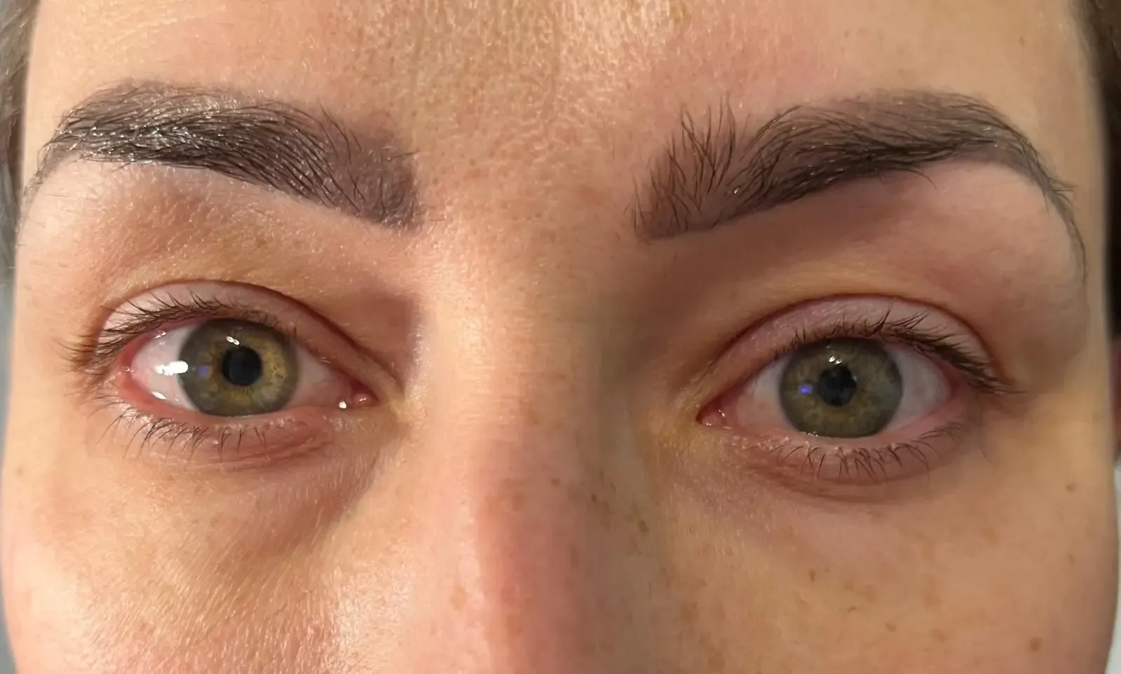 Efekt zabiegu kosmetologicznego - Po