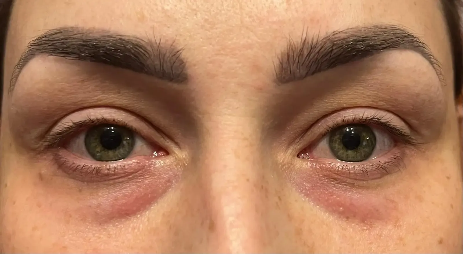 Efekt zabiegu kosmetologicznego - Przed