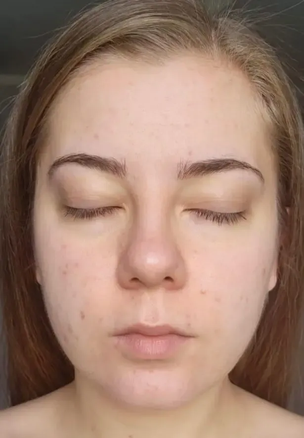 Efekt zabiegu kosmetologicznego - Po