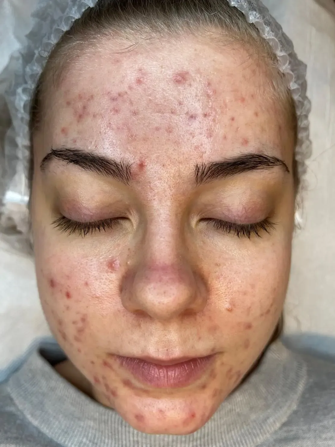 Efekt zabiegu kosmetologicznego - Przed