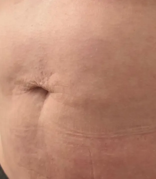 Efekt zabiegu kosmetologicznego - Po