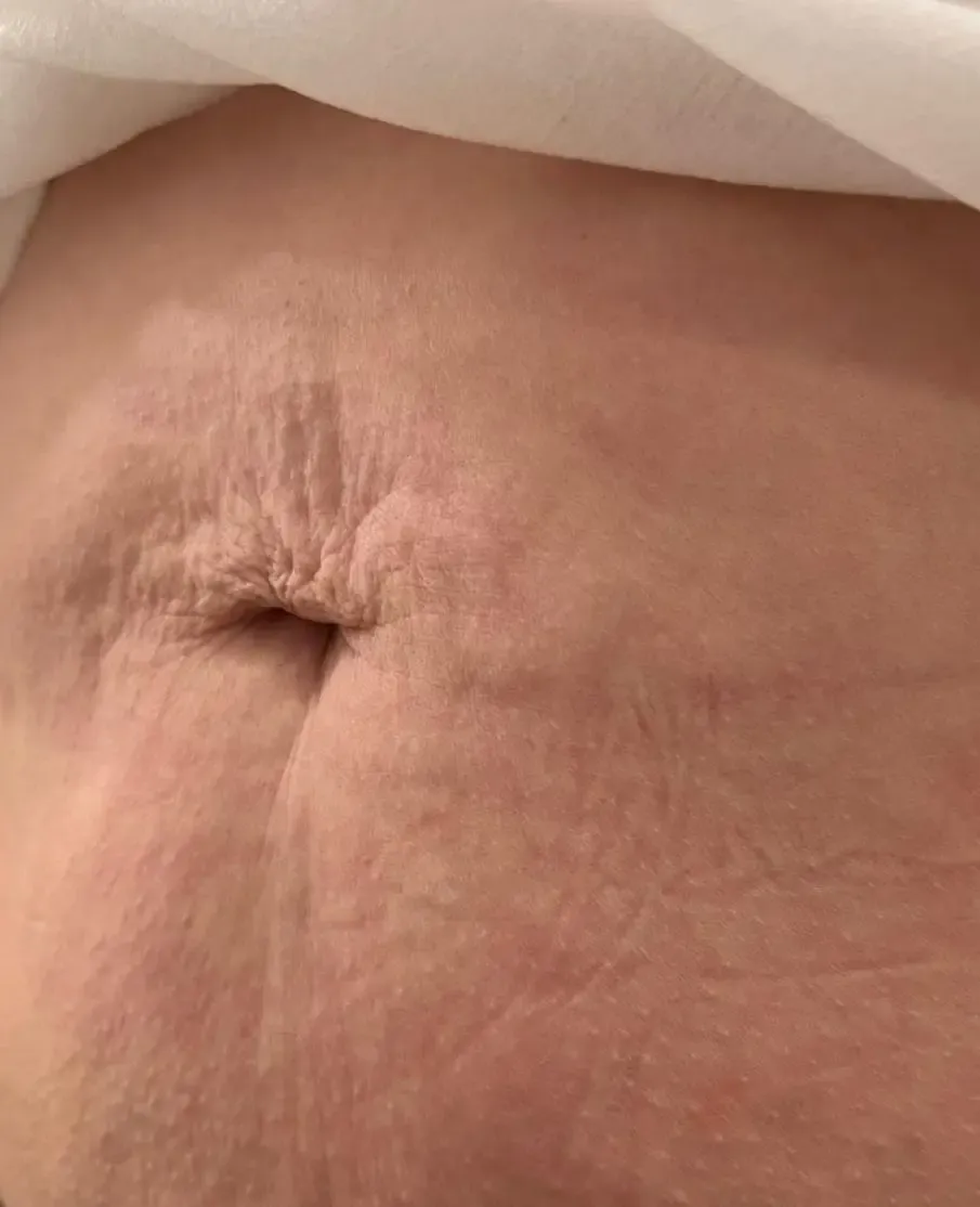 Efekt zabiegu kosmetologicznego - Przed