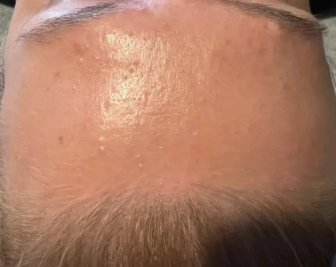 Efekt zabiegu kosmetologicznego - Po