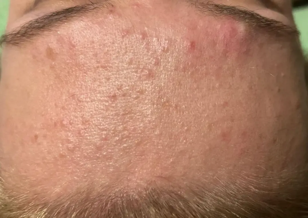 Efekt zabiegu kosmetologicznego - Przed